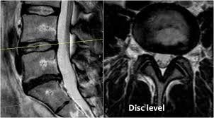 تشخیص فتق دیسک