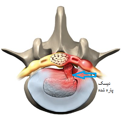 دیسک پاره شده