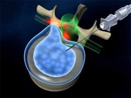 عمل لیزر دیسک کمر