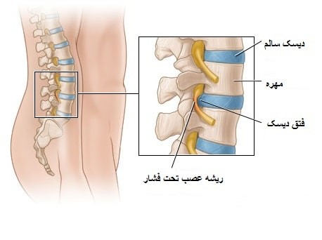 فتق دیسک چگونه است